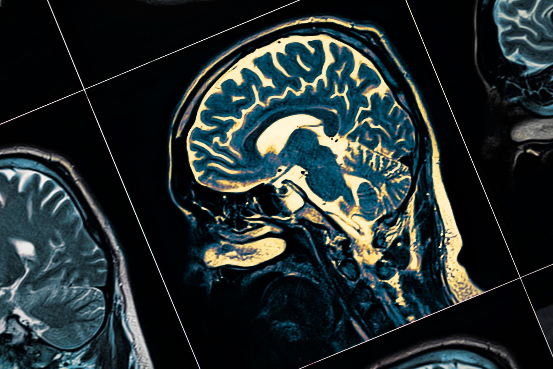 Dementia and air pollution