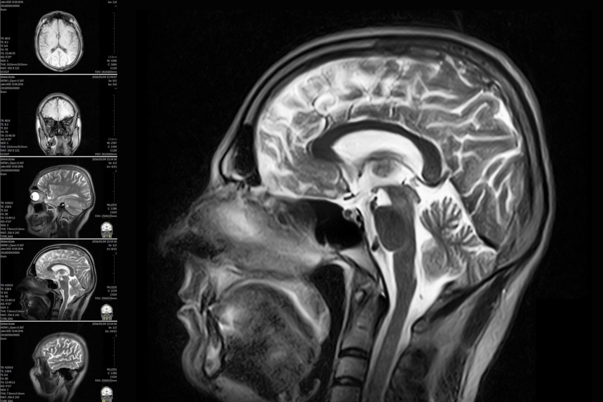 “Compared to autopsy brain samples from 2016, that’s about 50% higher."