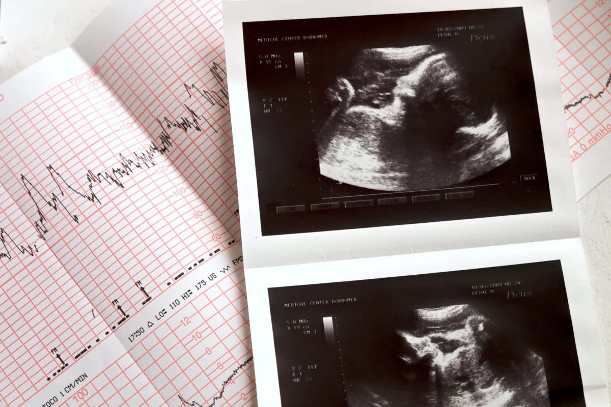 "The same jarring imagery of a fried egg could apply to fetal brain development in places with higher-than-recommended levels of ozone."
