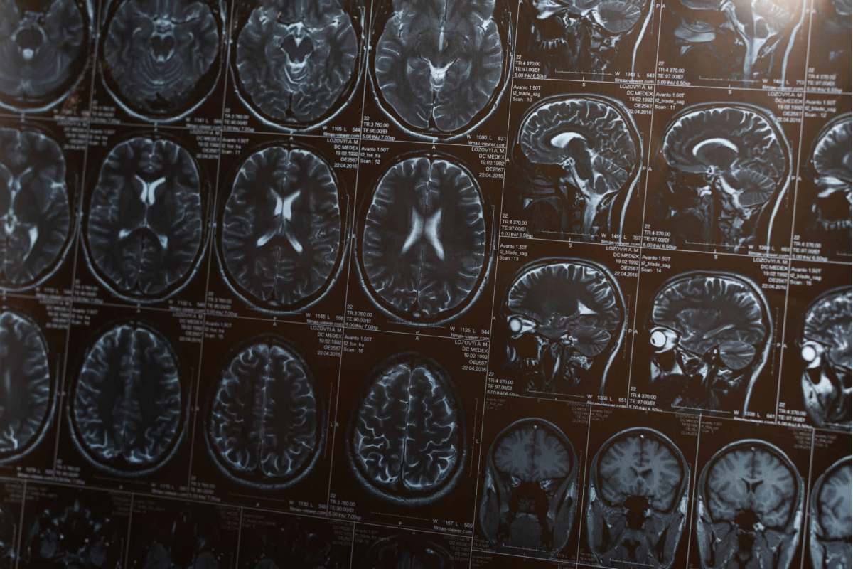 The study is one of many that have investigated this link with dementia.