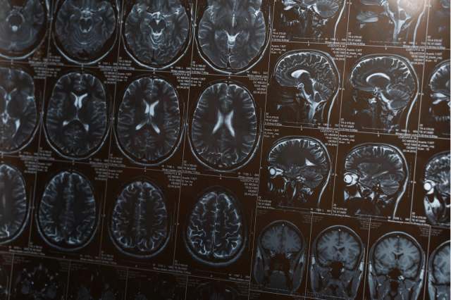 The study is one of many that have investigated this link with dementia.