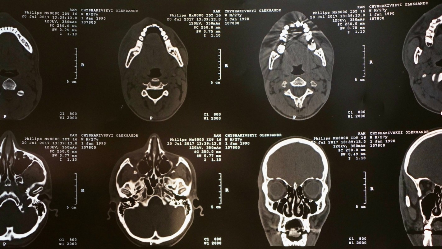 "There's the potential that these ... interfere with the connections between axons in the brain."